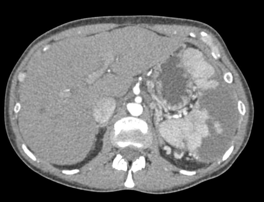 Multiple Splenic Infarcts - CTisus CT Scan