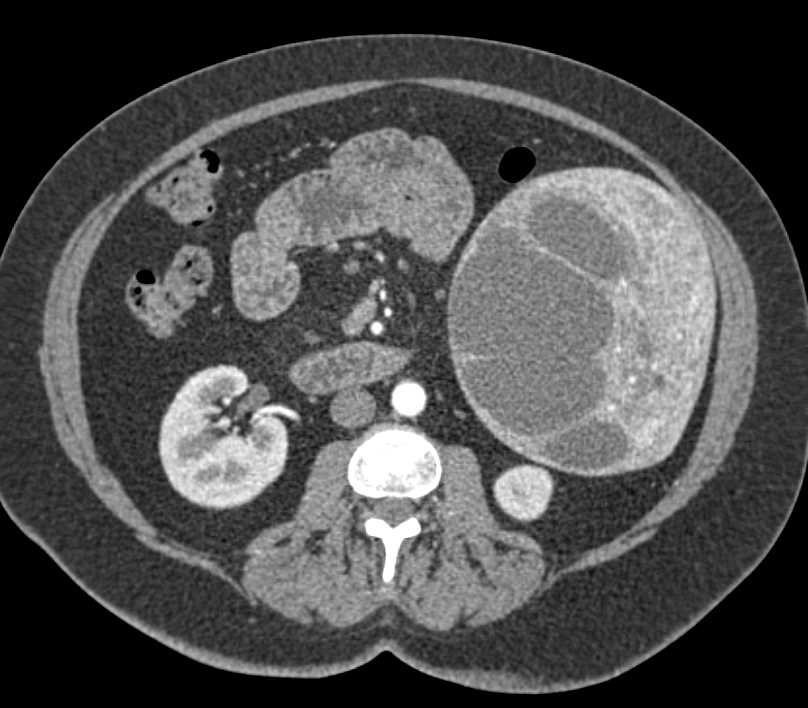 Epidermoid Cyst Spleen - CTisus CT Scan