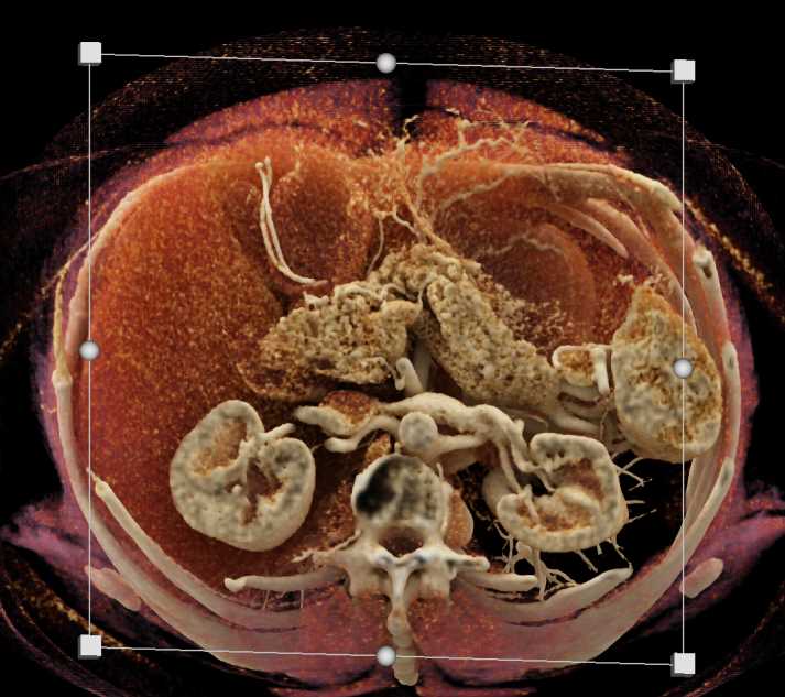 Epidermoid Cyst Spleen - CTisus CT Scan