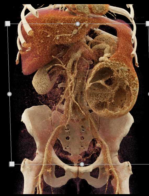 Epidermoid Cyst Spleen - CTisus CT Scan