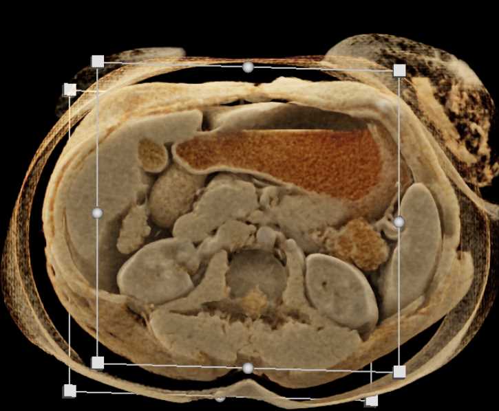 Cinematic Rendering of the Spleen - CTisus CT Scan