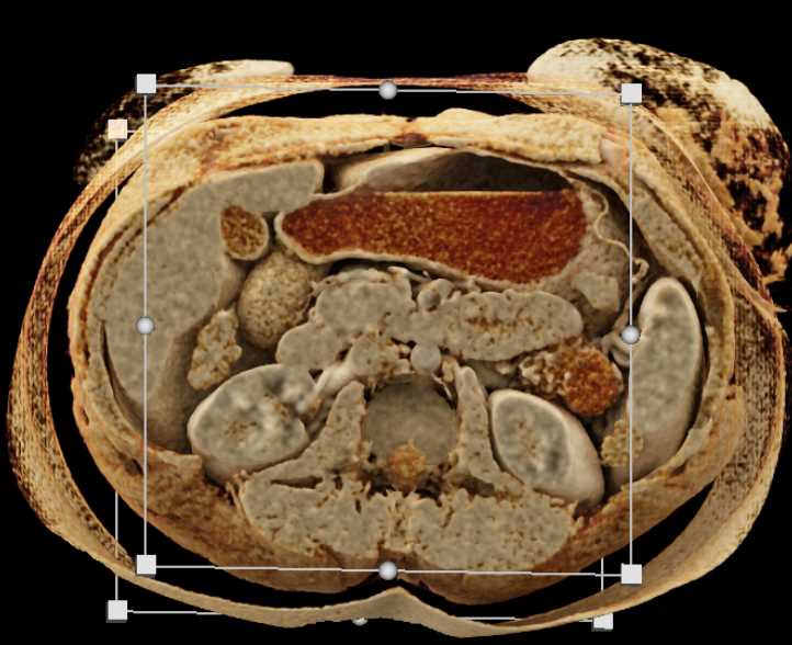 Cinematic Rendering of the Spleen - CTisus CT Scan