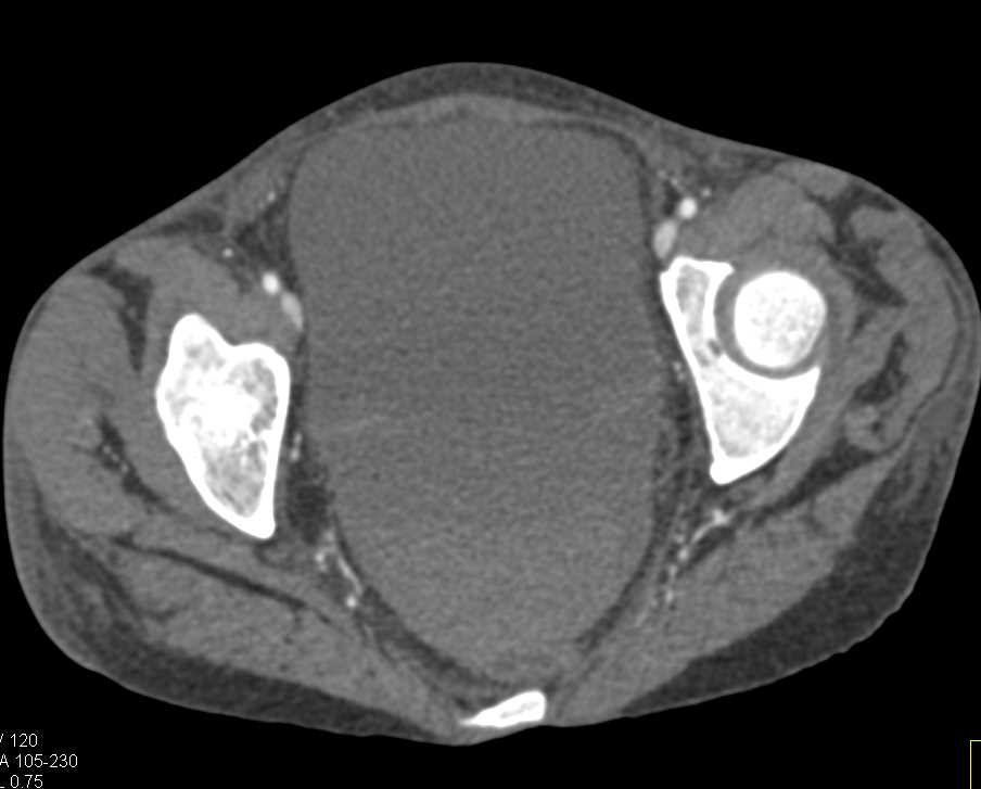 Splenic Hamartoma - CTisus CT Scan