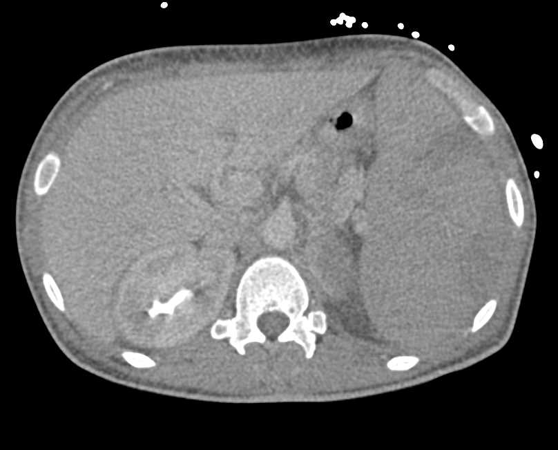 Splenomegaly with Multiple Splenic Infarcts - CTisus CT Scan