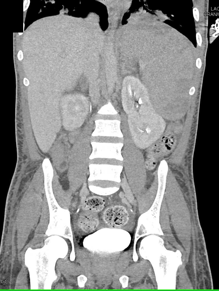 Splenomegaly with Multiple Splenic Infarcts - CTisus CT Scan