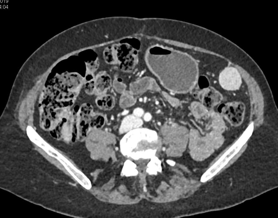 Accessory Spleen in the LLQ - CTisus CT Scan