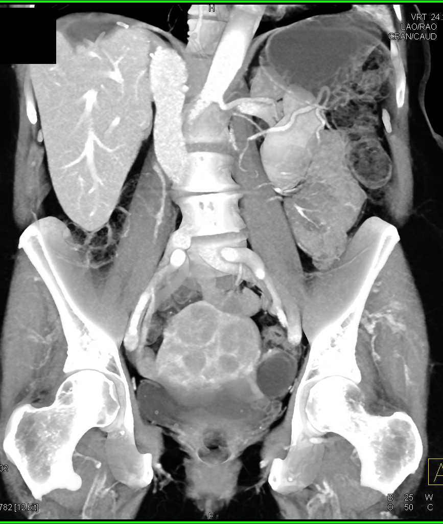 Accessory Spleen in the Left Lower Quadrant (LLQ) - CTisus CT Scan