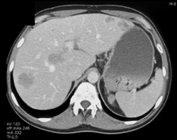 Metastatic Melanoma - CTisus CT Scan