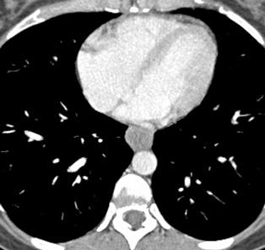 Duplication Cyst - CTisus CT Scan