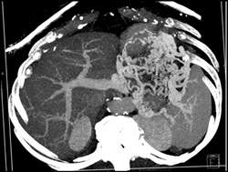 Gastric Varices Due to Splenic Vein Occlusion - CTisus CT Scan