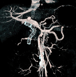 Stent in Common Bile Duct (CBD) - CTisus CT Scan