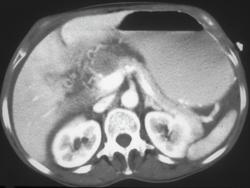 Gastric Cancer With Spread Into Perigastric Tissue Planes - CTisus CT Scan