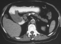 Carcinoma of the Gastric Antrum - CTisus CT Scan