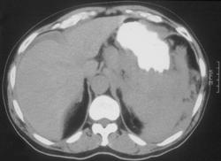 Gastric Leiomyosarcoma - CTisus CT Scan