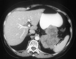 Gastric Leiomyosarcoma - CTisus CT Scan