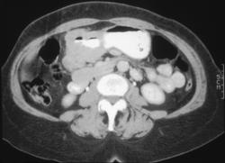 Gastric Adenocarcinoma - CTisus CT Scan