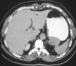 Gastric Leiomyoma - CTisus CT Scan