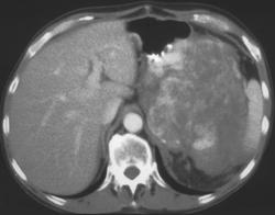 Gastric Leiomyosarcoma - CTisus CT Scan