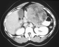 Gastric Leiomyosarcoma - CTisus CT Scan