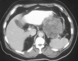 Gastric Leiomyosarcoma - CTisus CT Scan