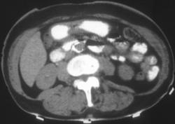 Metastases to the Stomach (breast Cancer) - CTisus CT Scan