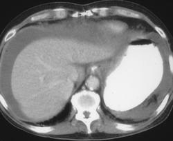 Gastric Cancer (fundus) With Carcinomatosis - CTisus CT Scan