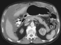 Carcinomatosis Secondary to Gastric Cancer - CTisus CT Scan