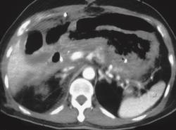 Necrosis of the Gastric Wall With Perforation - CTisus CT Scan