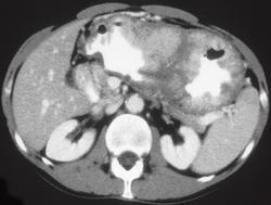 Menetrier's Disease - CTisus CT Scan