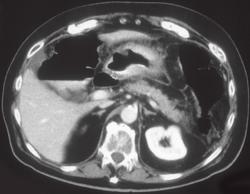 Linitis Plastica Stomach - CTisus CT Scan