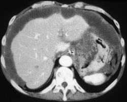 Gastric Adenocarcinoma With Carcinomatosis - CTisus CT Scan