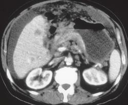 Gastric Cancer (antrum) With Carcinomatosis - CTisus CT Scan