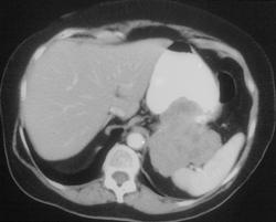 Gastric Leiomyosarcoma - CTisus CT Scan