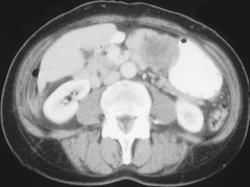 Gastric Leiomyosarcoma - CTisus CT Scan