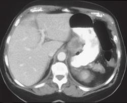 Adenocarcinoma Stomach With Ulceration - CTisus CT Scan