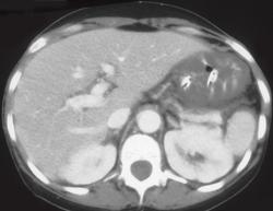 Severe Gastritis - CTisus CT Scan