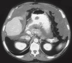 Antral Carcinoma With Pseudomyxoma Peritonei (PMP) - CTisus CT Scan