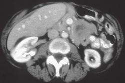 Gastric Leiomyosarcoma - CTisus CT Scan