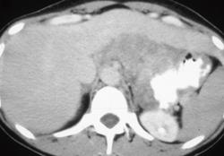 Gastric Adenocarcinoma - CTisus CT Scan