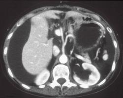 Gastric Cancer With Krukenberg Tumors of the Ovary - CTisus CT Scan