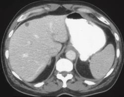 Gastric Lymphoma - CTisus CT Scan