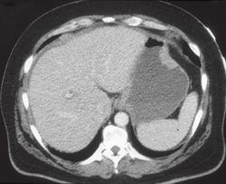 Gastric Lymphoma With Small Bowel Involvement - CTisus CT Scan