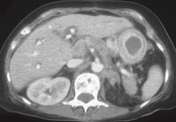 Linitis Plastica - CTisus CT Scan