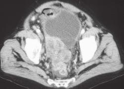 Drop Metastases on Rectum Due to Gastric Cancer - CTisus CT Scan