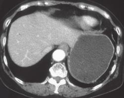 Normal Stomach - CTisus CT Scan