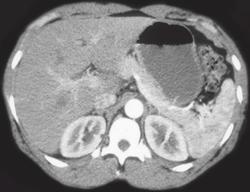 Normal Stomach - CTisus CT Scan