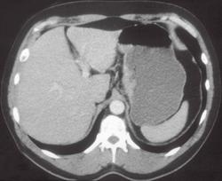 Subtle Carcinoma in Gastric Fundus - CTisus CT Scan