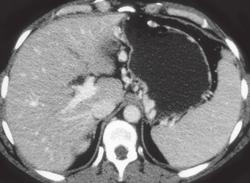 Large Varices Around Stomach Due to Portal Vein Occlusion - CTisus CT Scan