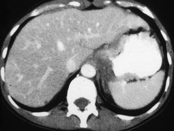 Gastric Adenocarcinoma - CTisus CT Scan