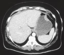 Gastric Lymphoma (unusually Subtle) - CTisus CT Scan